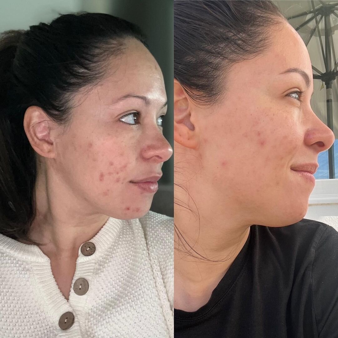 Gallery | Skincare results by Bloom Esthetics Gallery | Skincare results by Bloom Esthetics